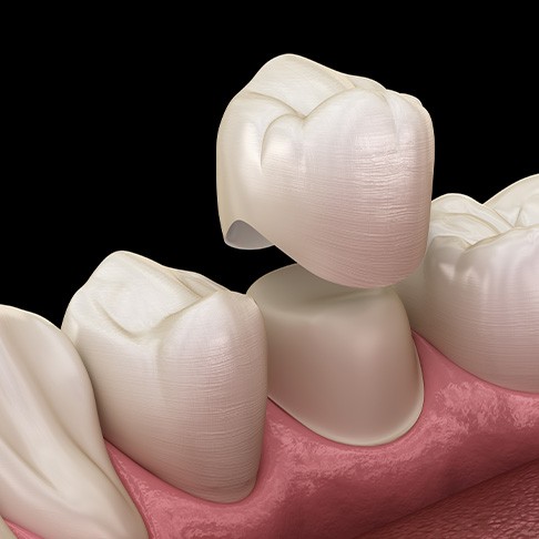 Dental crown treatment can vary in cost depending on a variety of factors