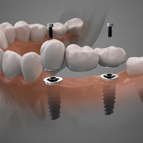 Digital illustration of dental implant supported bridge placement