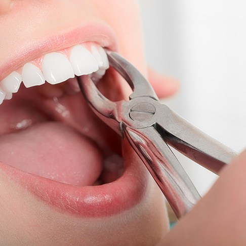 A dentist grabbing onto a dental patient’s infected tooth with tools