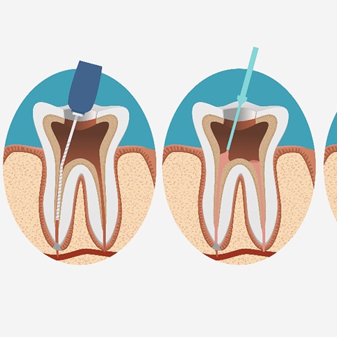 illustration for root canal therapy in Brookfield 