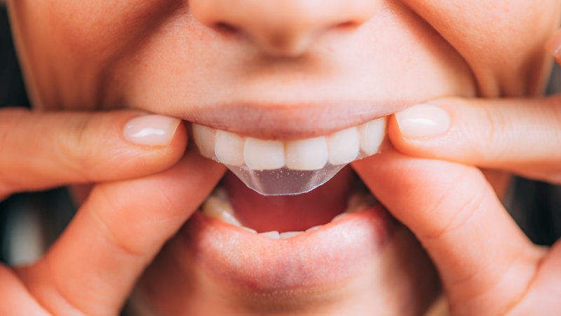 person using store-bought teeth whitening products 