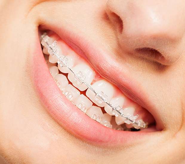 Brookfield Clear Braces