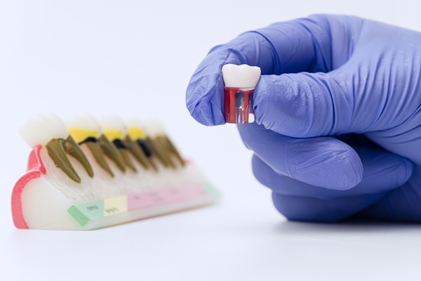 Alternatives To Dental Crowns: Exploring Other Dental Restoration Options