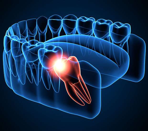 Brookfield Wisdom Teeth Extraction